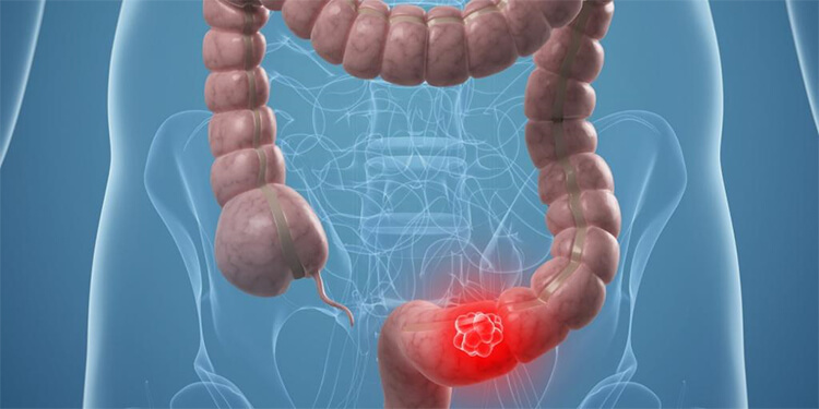 cancer de colon que hacer platyhelminthes sistem protonefridial