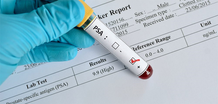 próstata mediante examen de sangre)